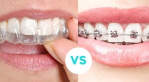 khác nhau của niềng răng trong suốt và niềng răng thông thường 