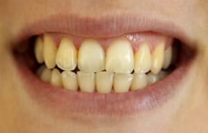 Răng ố vàng lâu ngày 