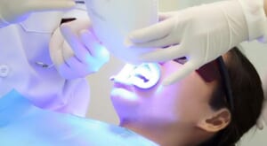 Tẩy trắng răng bằng phương pháp chiếu laser