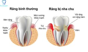 điều trị viêm nha chu