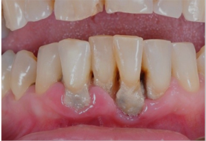 Tình trạng viêm nha chu