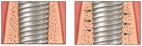 Cấu trúc trụ implant tích hợp với xương