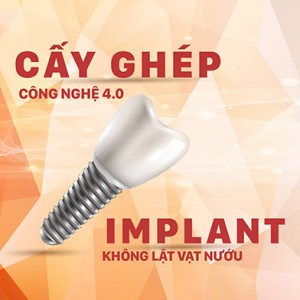 Cấy ghép Implant