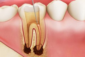 Điều trị nội nha