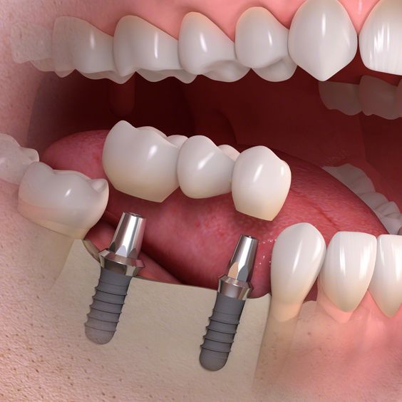 Trồng răng implant cho trường hợp mất nhiều răng 
