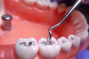 Trám răng thẩm mỹ
